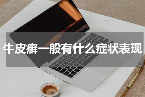 牛皮癣一般有什么症状表现